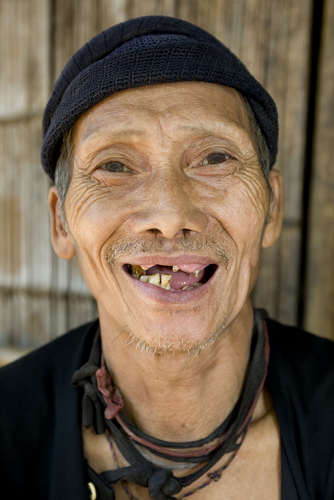 man-missing-teeth-aia-malaysia