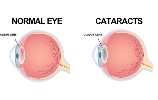 the-structure-of-the-eye-cataract-aia-malaysia