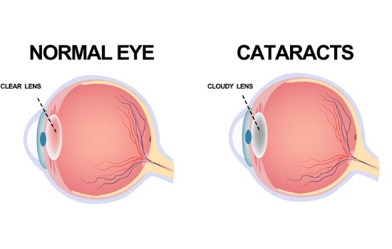 the-structure-of-the-eye-cataract-aia-malaysia